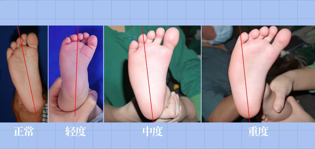 SPI足底壓力分布計量